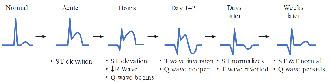 A timeline diagram illustrating the chronological progression of ECG changes during an ST-elevation myocardial infarction (STEMI) across six stages. 1. Normal: Baseline normal QRS complex, ST segment, and upright T wave. 2. Acute: Marked ST elevation with hyperacute tall T waves. 3. Hours: Persistent ST elevation, decreased R wave amplitude, and initiation of a Q wave. 4. Day 1–2: T wave inversion and deepening of the Q wave. 5. Days later: ST segment normalizes to baseline while T wave remains inverted. 6. Weeks later: ST segment and T wave return to normal, while the pathologic Q wave persists.
