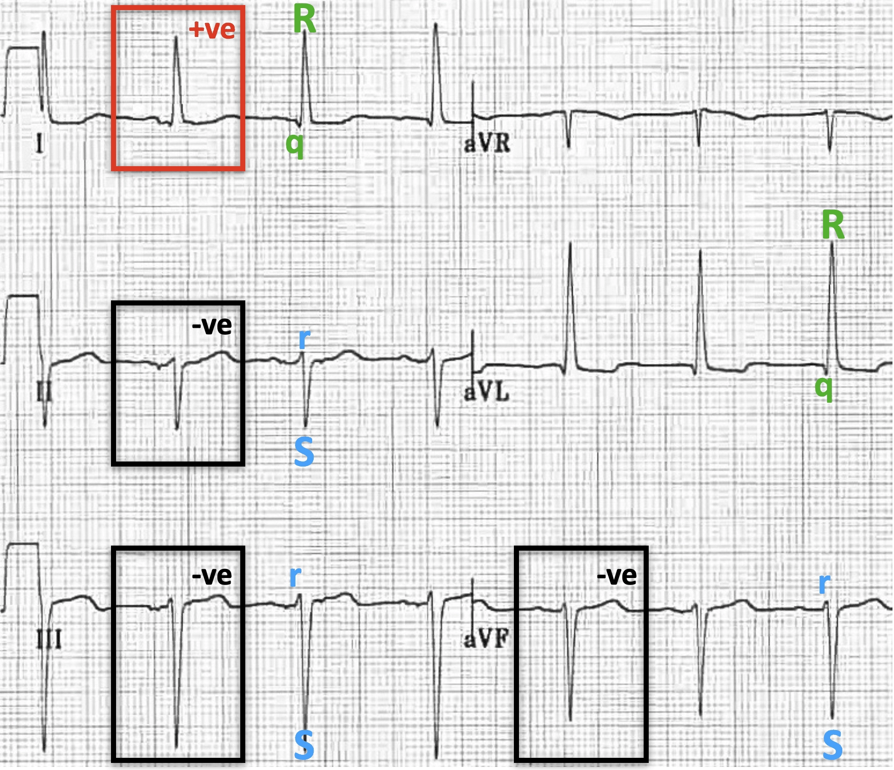 An ECG rhythm strip detailing findings of a Left Anterior Fascicular Block (LAFB) across frontal plane leads I, II, III, aVR, aVL, and aVF. Lead I shows a tall positive (+ve) QRS complex labeled with a small q wave and tall R wave (qR pattern) enclosed in a red box. Lead II shows a predominantly negative (-ve) QRS complex featuring a small r wave and deep S wave (rS pattern) in a black box. Lead III and lead aVF also exhibit predominantly negative (-ve) rS complexes highlighted in black boxes, reflecting left axis deviation. Lead aVL shows a tall positive qR pattern.