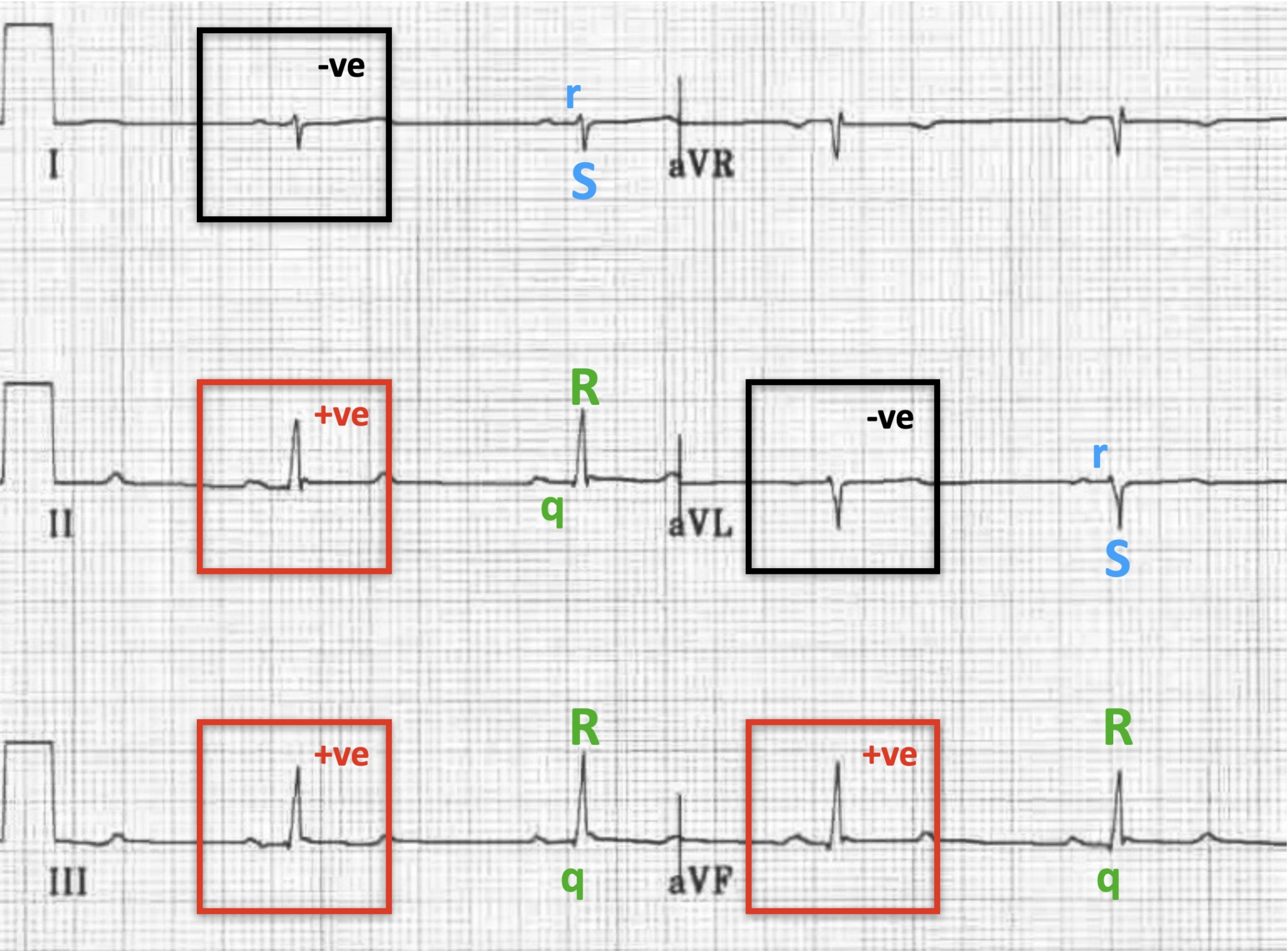 An ECG rhythm strip detailing findings of a Left Posterior Fascicular Block (LPFB) across frontal plane leads I, II, III, aVR, aVL, and aVF. Lead I shows a predominantly negative (-ve) QRS complex featuring a small r wave and S wave (rS pattern) highlighted in a black box. Lead II shows a tall positive (+ve) QRS complex labeled with a small q wave and tall R wave (qR pattern) in a red box. Lead III and lead aVF both display tall positive (+ve) qR complexes enclosed in red boxes, reflecting right axis deviation. Lead aVL shows a negative (-ve) rS complex in a black box.