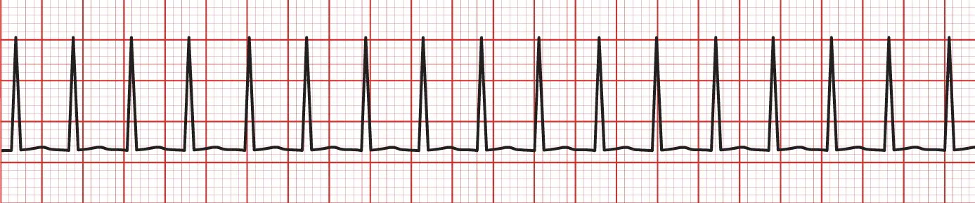 An ECG rhythm strip on red grid paper displaying paroxysmal supraventricular tachycardia (PSVT). The tracing demonstrates a very rapid, perfectly regular narrow-complex tachycardia featuring tall, sharp QRS complexes spaced closely together across the entire strip. Distinct P waves are absent or buried within the QRS complexes, and the baseline between beats appears flat with minimal visible repolarization wave detail due to the fast rate.