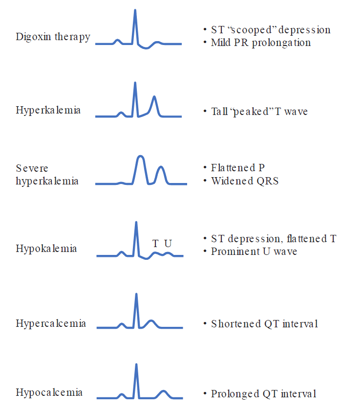 A vertical chart illustrating characteristic ECG ST and T-wave abnormalities associated with specific electrolyte imbalances and medications. 1. Digoxin therapy: ST "scooped" depression and mild PR prolongation. 2. Hyperkalemia: Tall "peaked" T wave. 3. Severe hyperkalemia: Flattened P wave and widened QRS complex. 4. Hypokalemia: ST depression, flattened T wave, and a prominent U wave. 5. Hypercalcemia: Shortened QT interval. 6. Hypocalcemia: Prolonged QT interval.
