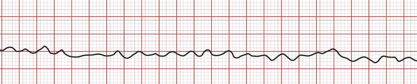 An ECG rhythm strip on red grid paper displaying fine ventricular fibrillation (VF). The tracing shows a completely disorganized, rapid, and chaotic baseline with low-amplitude, irregular undulations. There are no recognizable P waves, QRS complexes, or T waves throughout the entire strip.
