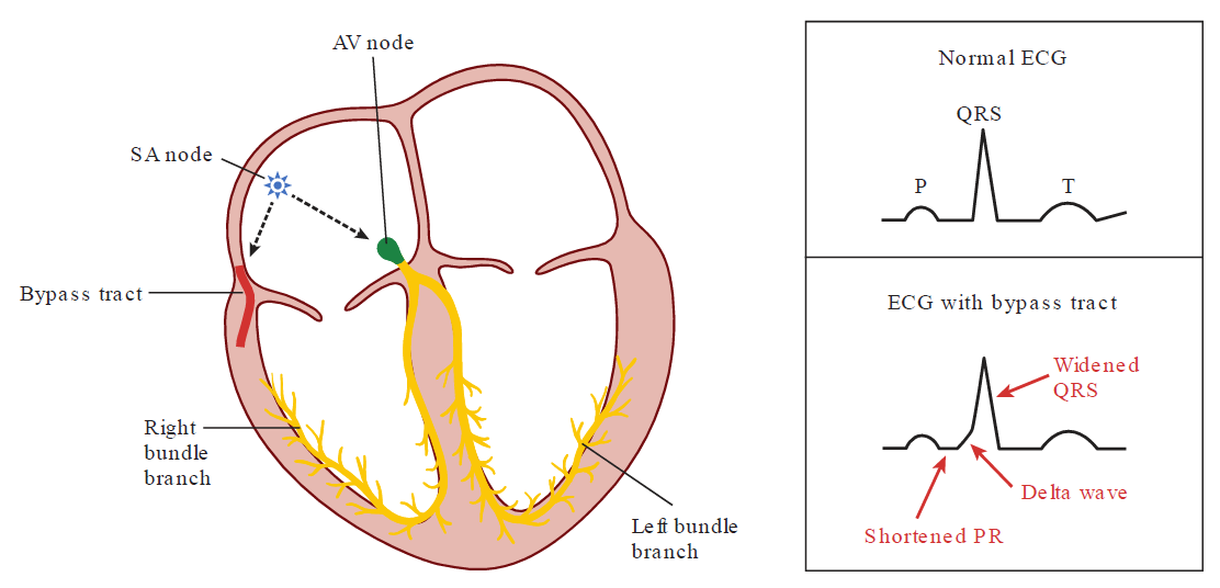 A medical illustration and ECG comparison diagram explaining Wolff-Parkinson-White (WPW) syndrome. The left side shows a cross-section of the heart depicting the conduction system—the SA node, AV node, and right and left bundle branches—alongside an abnormal red "Bypass tract" (accessory pathway) connecting the atrium directly to the ventricle. The right side features two boxed ECG tracings: the top box displays a "Normal ECG" with labeled P, QRS, and T waves, while the bottom box displays an "ECG with bypass tract" highlighting three key findings with red arrows: a "Shortened PR" interval, a slurred initial upstroke called a "Delta wave", and a "Widened QRS" complex.