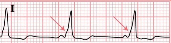 An ECG rhythm strip from lead I on red grid paper displaying Wolff-Parkinson-White (WPW) syndrome. The tracing shows three cardiac cycles, each featuring a short PR interval leading directly into a widened QRS complex. Pink arrows point to the slurred, sloped upstroke at the beginning of the QRS complex, representing a delta wave caused by pre-excitation through an accessory pathway.