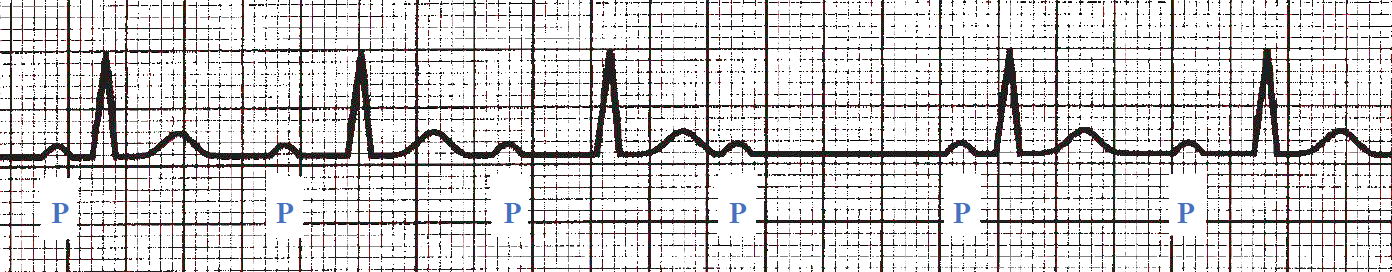 An ECG rhythm strip on standard grid paper displaying Second-Degree AV Block, Type I (Wenckebach/Mobitz I). The tracing shows six P waves, labeled with blue "P" letters below. The PR interval progressively lengthens across the first three cardiac cycles until the fourth P wave fails to conduct a QRS complex, resulting in a dropped beat. Following this pause, the cycle resets with the fifth P wave showing a shorter PR interval and conducting a QRS complex.