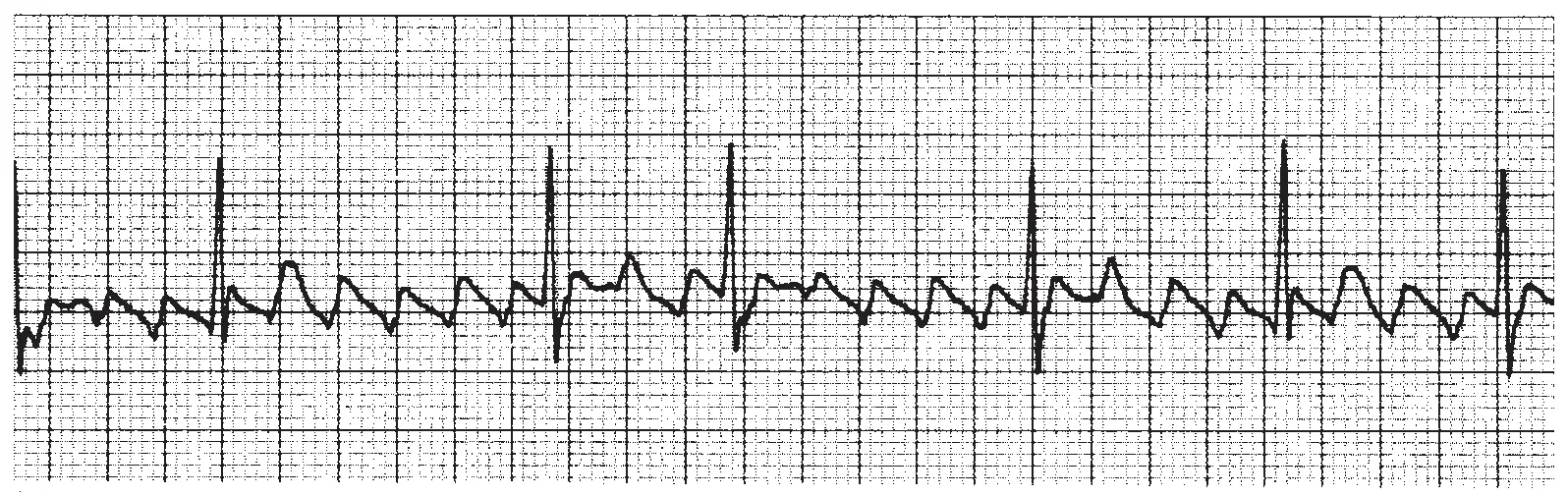 An ECG rhythm strip on standard grid paper displaying atrial flutter. The baseline features continuous, rapid, and regular saw-toothed flutter waves (F waves) with no flat isoelectric intervals between them. Narrow QRS complexes appear at regular, wider intervals along the strip, demonstrating AV conduction with a fixed block ratio relative to the flutter waves.
