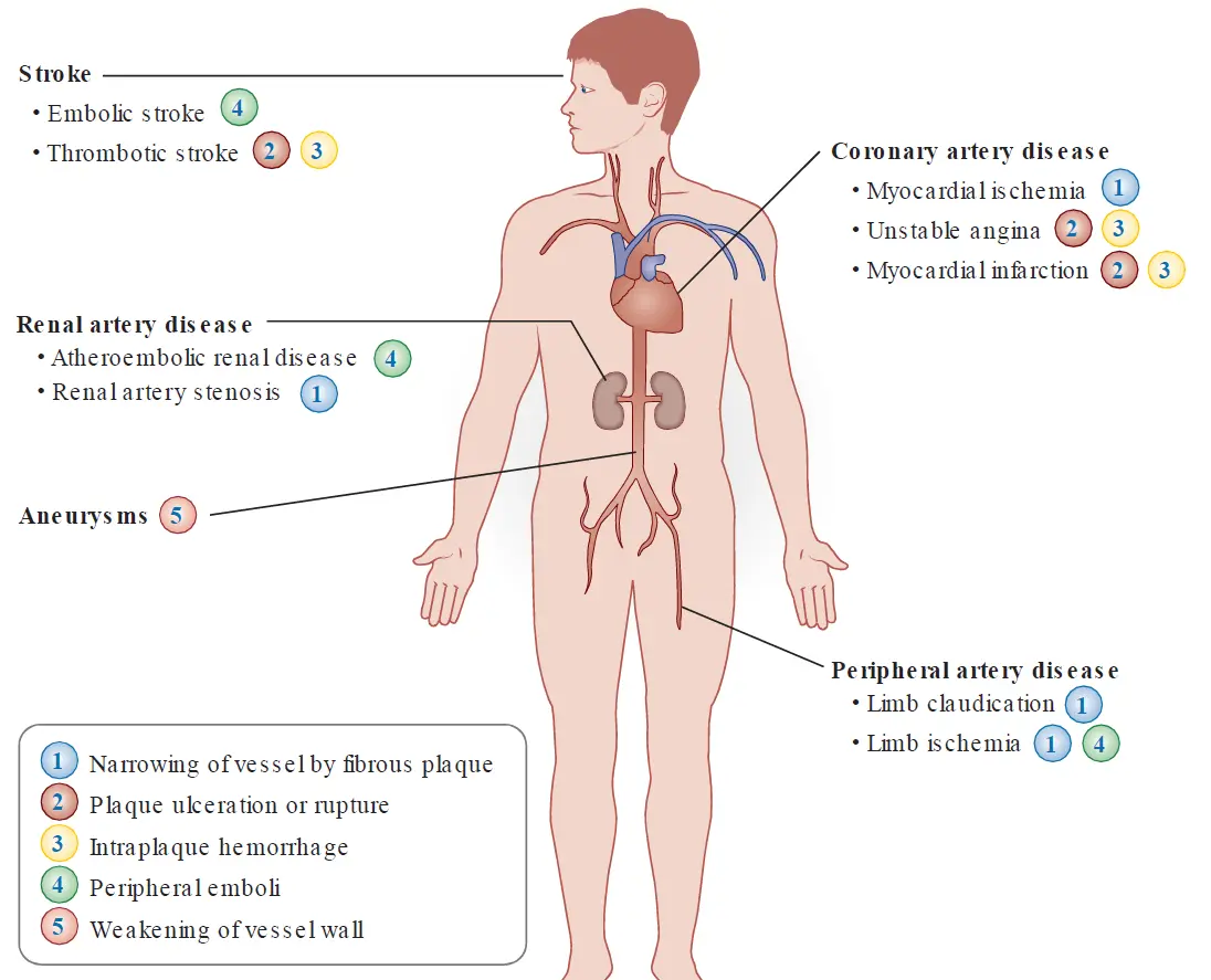 Anatomical illustration of a human body mapping the clinical complications of atherosclerosis. Labels point to specific conditions including stroke (embolic or thrombotic), coronary artery disease (myocardial ischemia, unstable angina, or myocardial infarction), renal artery disease (atheroembolic or stenosis), aneurysms, and peripheral artery disease. A key correlates these complications with pathological mechanisms like narrowing by fibrous plaque, plaque rupture, or vessel wall weakening.