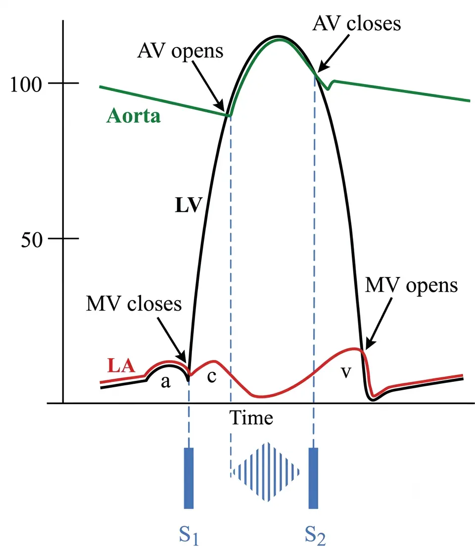 A simplified pressure curve diagram showing the timing of an ejection systolic murmur during the cardiac cycle. It plots pressure lines over time for the aorta (green), left ventricle (black, LV), and left atrium (red, LA). At the bottom, standard heart sounds S1 and S2 are labeled, with a blue diamond-shaped phonocardiogram shading pattern placed between them to represent a crescendo-decrescendo (diamond-shaped) systolic murmur occurring between S1 and S2.
