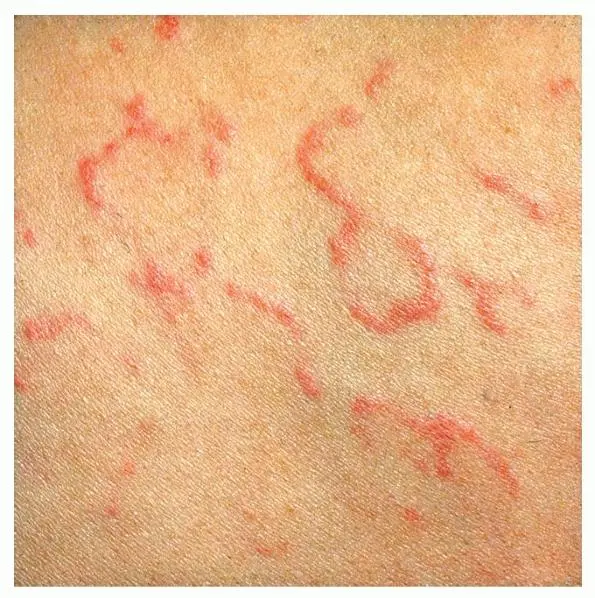 Clinical photo of erythema marginatum on fair skin featuring multiple non-pruritic, ring-like reddish patches with sharp, raised serpiginous borders and pale, normal-appearing central areas.
