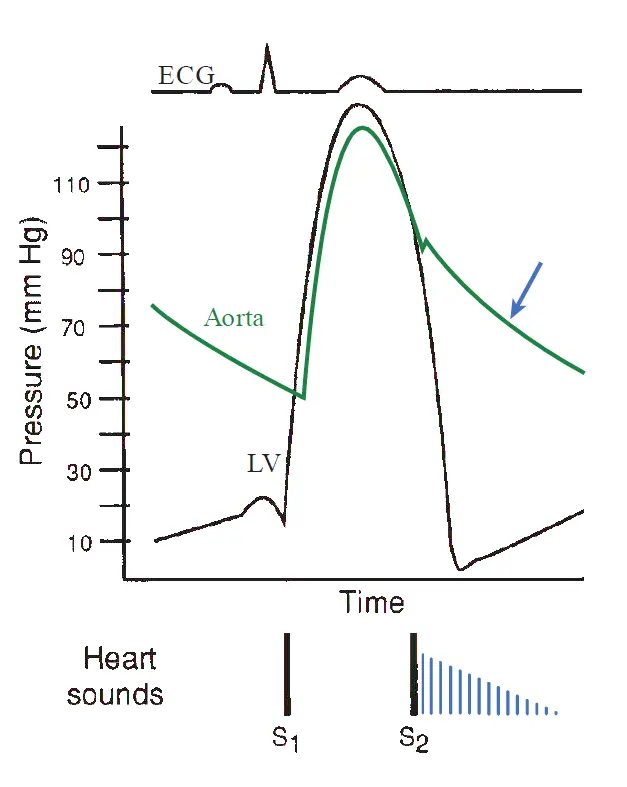 Pressure tracings of the aorta and left ventricle demonstrating a wide pulse pressure with a steep diastolic pressure decay in aortic regurgitation, accompanied by a phonocardiogram illustrating a high-pitched early diastolic decrescendo murmur