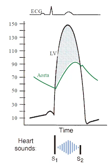 Simultaneous left ventricular and aortic pressure curves illustrating a large systolic pressure gradient characteristic of aortic stenosis, alongside an ECG trace and a phonocardiogram showing a classic diamond-shaped crescendo-decrescendo murmur