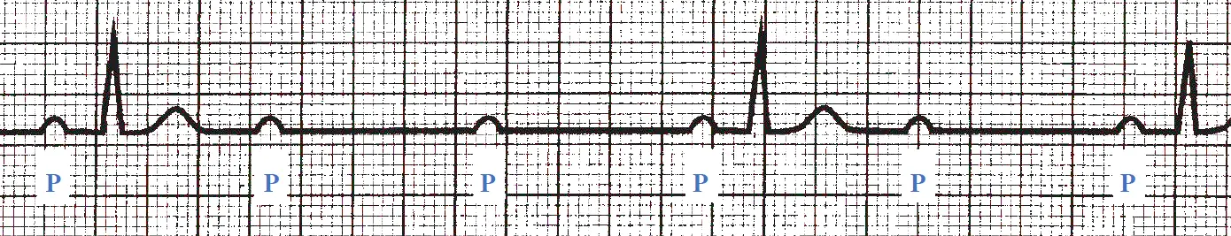An ECG rhythm strip on standard grid paper displaying high-degree (high-grade) AV block with a 2:1 conduction pattern. Six consecutive, regularly spaced P waves are labeled below with blue "P" characters. Every second P wave fails to conduct, resulting in a non-conducted P wave with no subsequent QRS complex, alternating with a conducted P wave that is followed by a narrow QRS complex and a T wave.