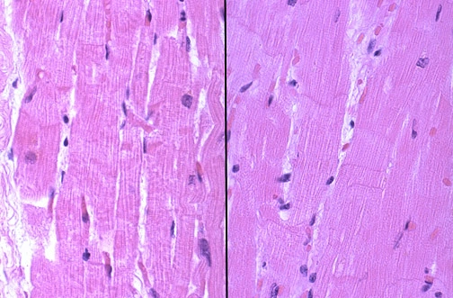 Histological view of an evolving myocardial infarction less than 12 hours old, displaying early loss of cross-striations with intact nuclei and no inflammatory infiltrate.