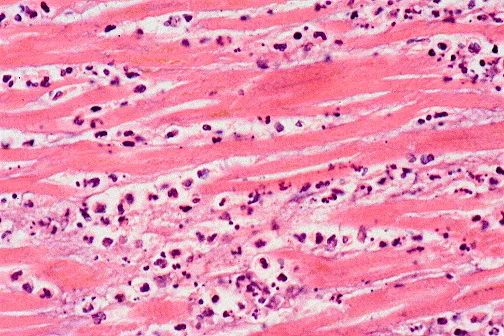 Histological view of an acute myocardial infarction several days old, showing marked coagulative necrosis and a prominent neutrophilic infiltrate.