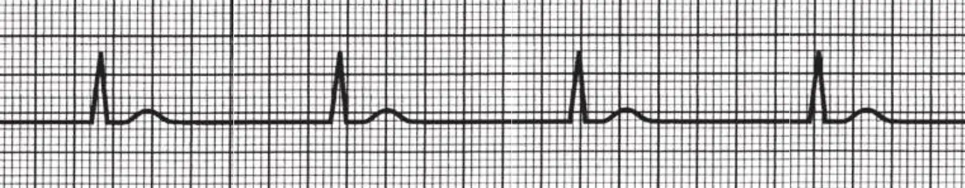 An ECG rhythm strip on standard grid paper displaying a junctional escape rhythm. The tracing shows four regularly spaced cardiac cycles across a slow rate. Each cycle consists of a normal-width, narrow QRS complex immediately followed by a low-amplitude T wave, with complete absence of preceding P waves and long, flat isoelectric intervals between beats.