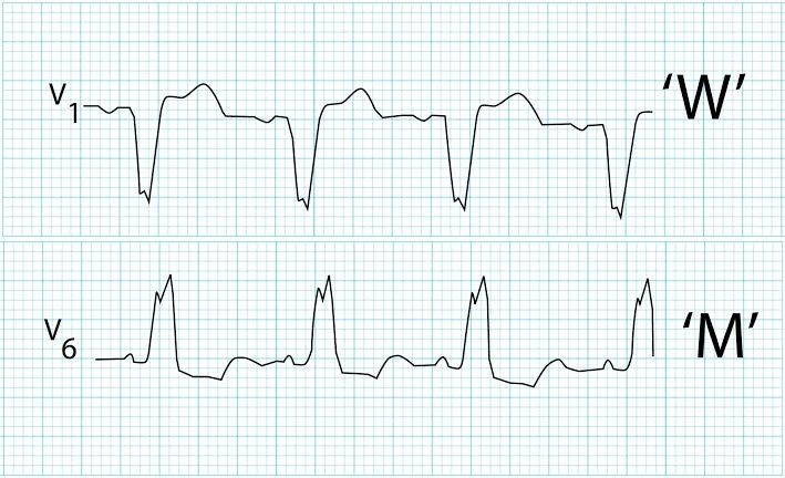 An ECG rhythm strip displaying chest leads V1 and V6 characteristic of a Left Bundle Branch Block (LBBB). Top strip (Lead V1): Shows wide QRS complexes with a broad, deep downward deflection forming a W shape (rS or QS complex) followed by an upright T wave, with a large letter W labeled on the right side. Bottom strip (Lead V6): Shows wide QRS complexes with a notched, broad positive deflection forming an M shape (RSR' pattern) with absent Q waves, labeled with a large letter M on the right side.