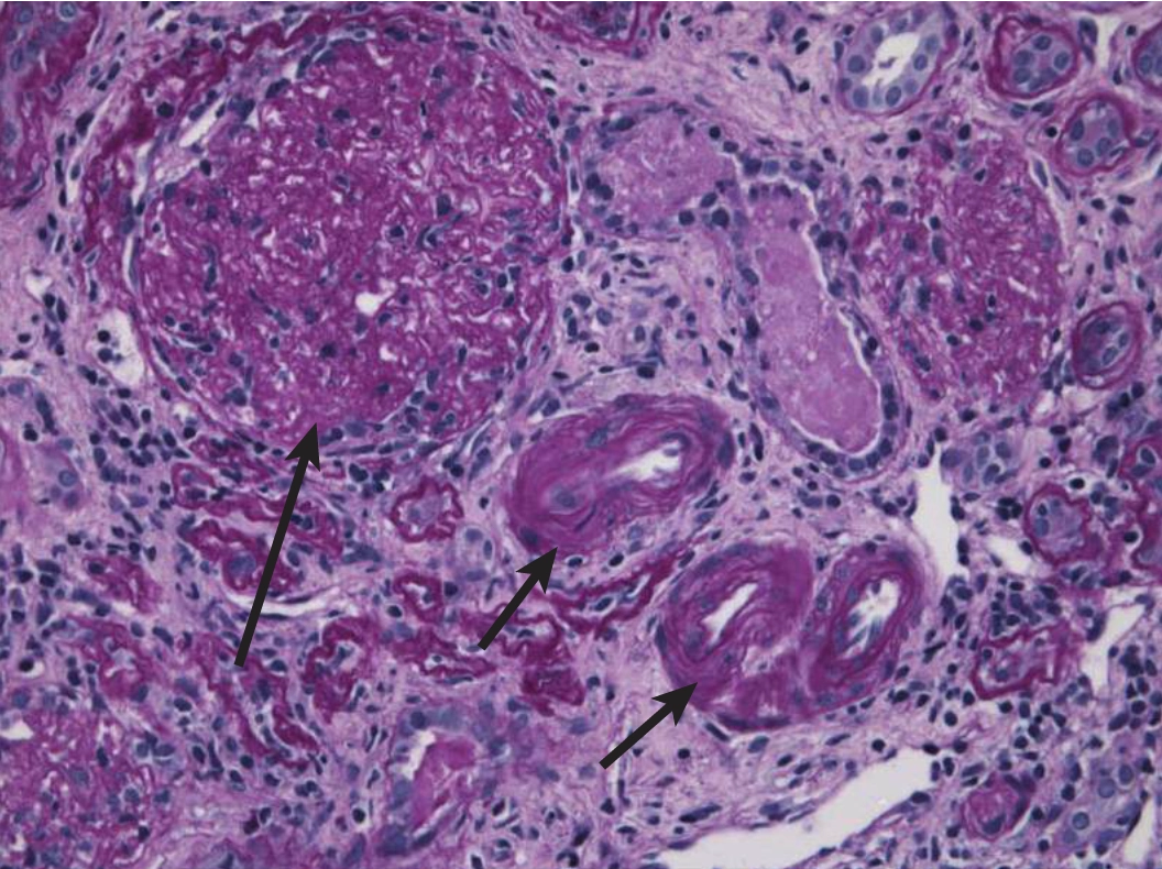 A histological cross-section micrograph of kidney tissue demonstrating benign nephrosclerosis stained with Periodic acid–Schiff (PAS). The image shows marked arteriolosclerosis where two arteriolar walls, pointed to by short black arrows near the center and lower right, are prominently thickened with homogeneous, pink hyaline deposits that narrow the vascular lumens. On the upper left, a long black arrow points to a large, globally sclerosed glomerulus featuring collapsed capillary loops and dense matrix accumulation resulting from chronic ischemia and reduced vascular supply.