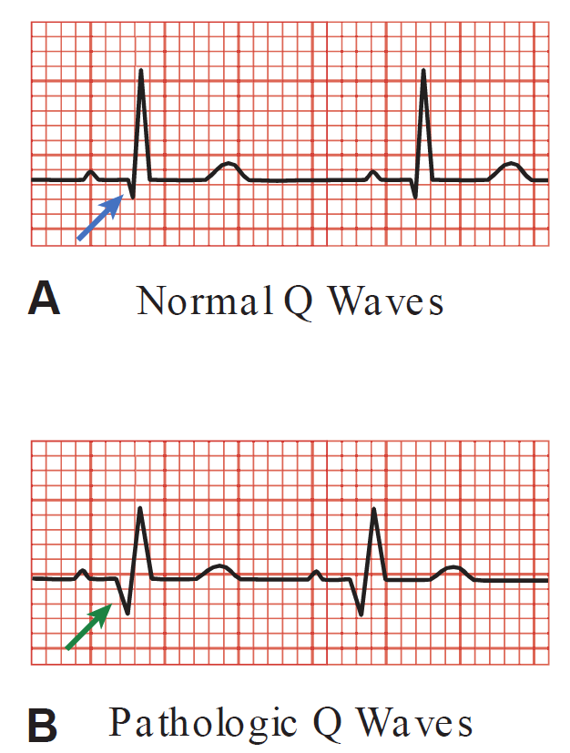A two-panel ECG comparison diagram (A, B) illustrating the difference between normal and pathologic Q waves. Panel A (Normal Q Waves): An ECG tracing on a red grid displaying a small, narrow initial downward deflection (blue arrow) preceding the R wave, representing physiological septal depolarization. Panel B (Pathologic Q Waves): An ECG tracing displaying a significantly deeper and wider downward deflection (green arrow) preceding the R wave, characteristic of myocardial infarction or necrosis.