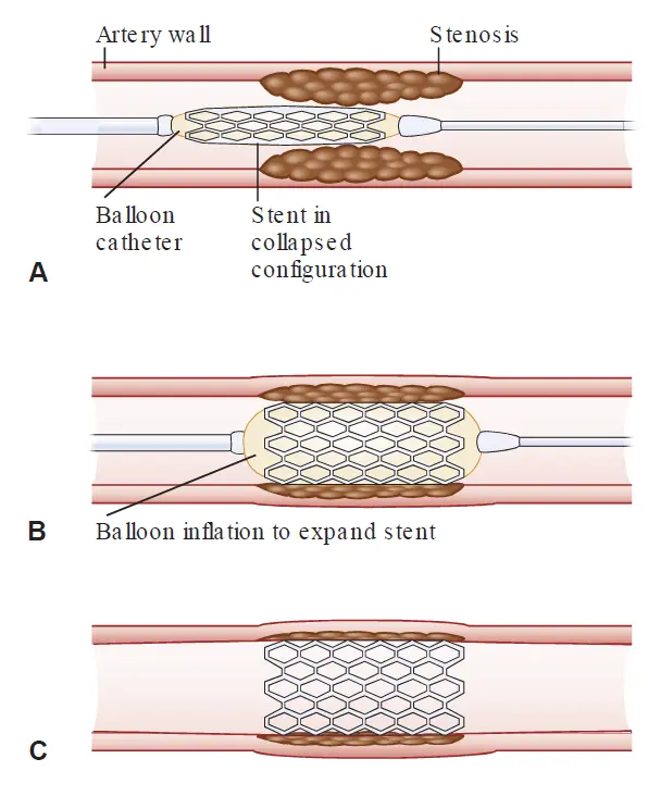 Three-panel diagram labeled A, B, and C illustrating percutaneous coronary intervention with stent placement. A: A collapsed stent mounted on an uninflated balloon catheter positioned within a narrowed artery at the site of atherosclerotic plaque (stenosis). B: The balloon is inflated to expand the metallic mesh stent against the artery wall, compressing the plaque. C: The balloon is deflated and removed, leaving the expanded stent in place to hold the artery open and restore blood flow.