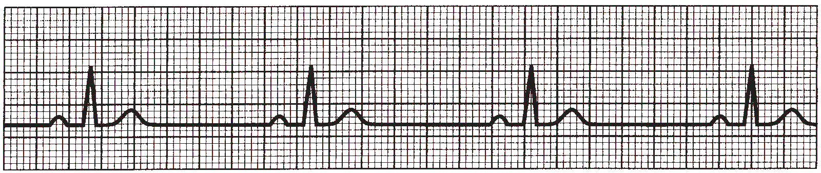 An ECG rhythm strip on standard grid paper displaying sinus bradycardia. The tracing shows four complete cardiac cycles spaced evenly but widely apart across the strip, indicating a slow heart rate under 60 bpm. Each cycle consists of a normal, upright P wave, followed by a sharp, narrow QRS complex, and a normal upright T wave, separated by long, flat isoelectric baseline intervals.