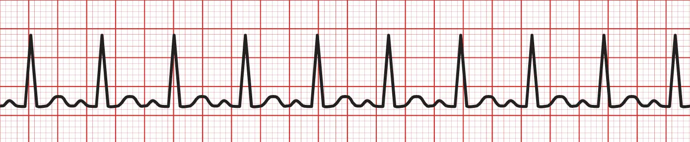 An ECG rhythm strip on red grid paper displaying sinus tachycardia. The tracing shows a rapid, regular rhythm with ten closely spaced cardiac cycles across the strip. Each cycle is characterized by a normal upright P wave, a sharp and narrow QRS complex, and an upright T wave, separated by very short baseline intervals due to the elevated heart rate.