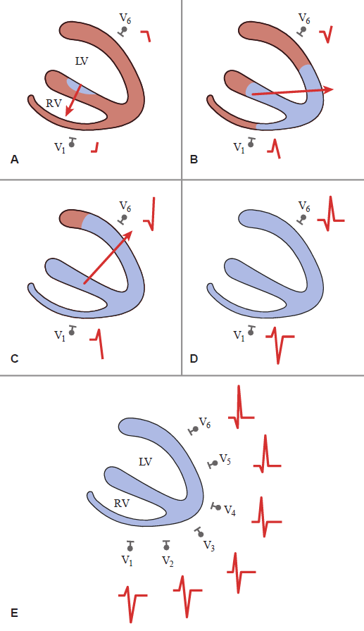 A five-panel diagram (A, B, C, D, E) showing the sequence of ventricular depolarization and corresponding ECG trace developments in precordial leads V1 through V6. Panel A: Septal depolarization begins with a red vector arrow pointing anteriorly and rightward toward V1, generating an initial small upward deflection in V1 and a small downward Q wave in V6. Panel B: Depolarization spreads toward the apex with the vector turning leftward toward V6, beginning an upward deflection in V6 and initiating a downward deflection in V1. Panel C: Depolarization spreads through the thick lateral wall of the left ventricle (LV) with the dominant vector arrow pointing posteriorly and leftward toward V6, causing a peak upward R wave in V6 and a deep downward S wave in V1. Panel D: Complete ventricular depolarization occurs with no net vector, returning both V1 and V6 ECG traces to baseline. Panel E: A cross-sectional view shows the complete spectrum of normal R-wave progression across leads V1 through V6, demonstrating a transition from a predominantly negative rS complex in V1 to a tall positive qR complex in V6.
