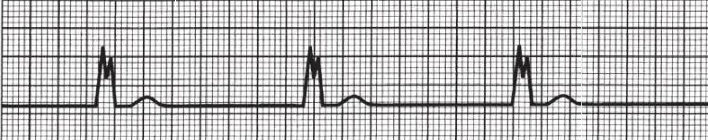 An ECG rhythm strip on standard grid paper displaying a ventricular escape rhythm (idioventricular rhythm). The tracing shows a slow, regular rhythm with three widely spaced cardiac cycles. Each cycle consists of a wide, notched QRS complex followed by a low T wave, with a completely flat baseline and no preceding P waves visible.