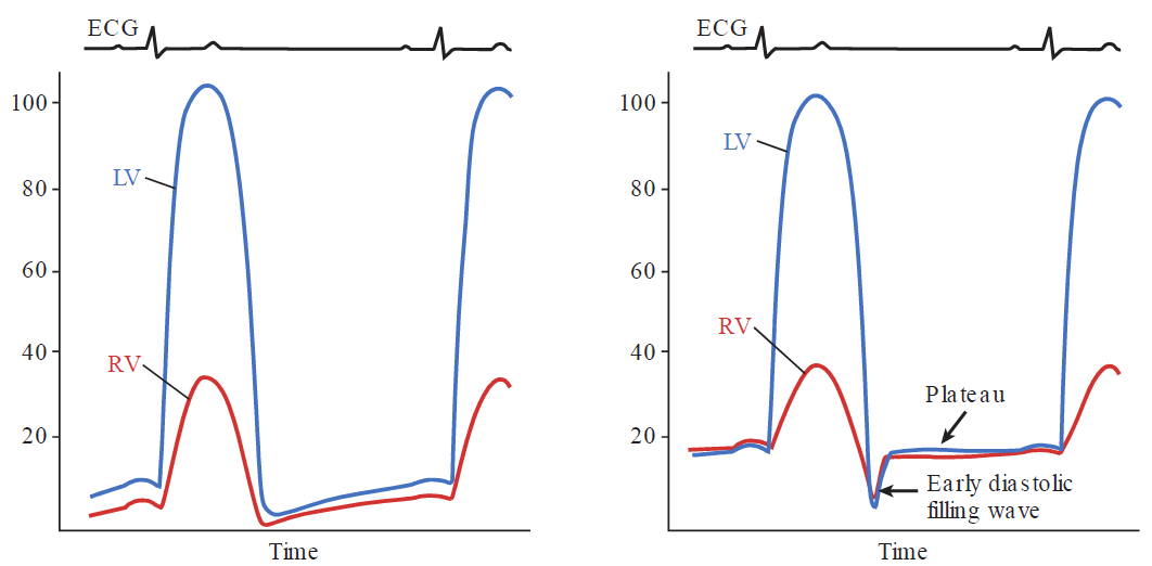 Two ventricular pressure tracing graphs side-by-side against time, with aligned ECG signals above each, comparing a normal heart to constrictive pericarditis. The vertical axes measure pressure in mmHg from 0 to 100, displaying left ventricular (LV) pressure in blue and right ventricular (RV) pressure in red. On the left, the Normal graph shows LV peak systolic pressure around 100 mmHg and RV peak around 30 mmHg, followed by a gradual, low-pressure diastolic fill where LV and RV pressures remain separate and low. On the right, the Constrictive Pericarditis graph shows the classic "dip and plateau" or "square root sign" pattern: early diastole features a rapid dip labeled "Early diastolic filling wave", immediately followed by an abrupt, elevated "Plateau" where LV and RV diastolic pressures equalize near 15–20 mmHg throughout mid-to-late diastole due to the rigid pericardial constraint.